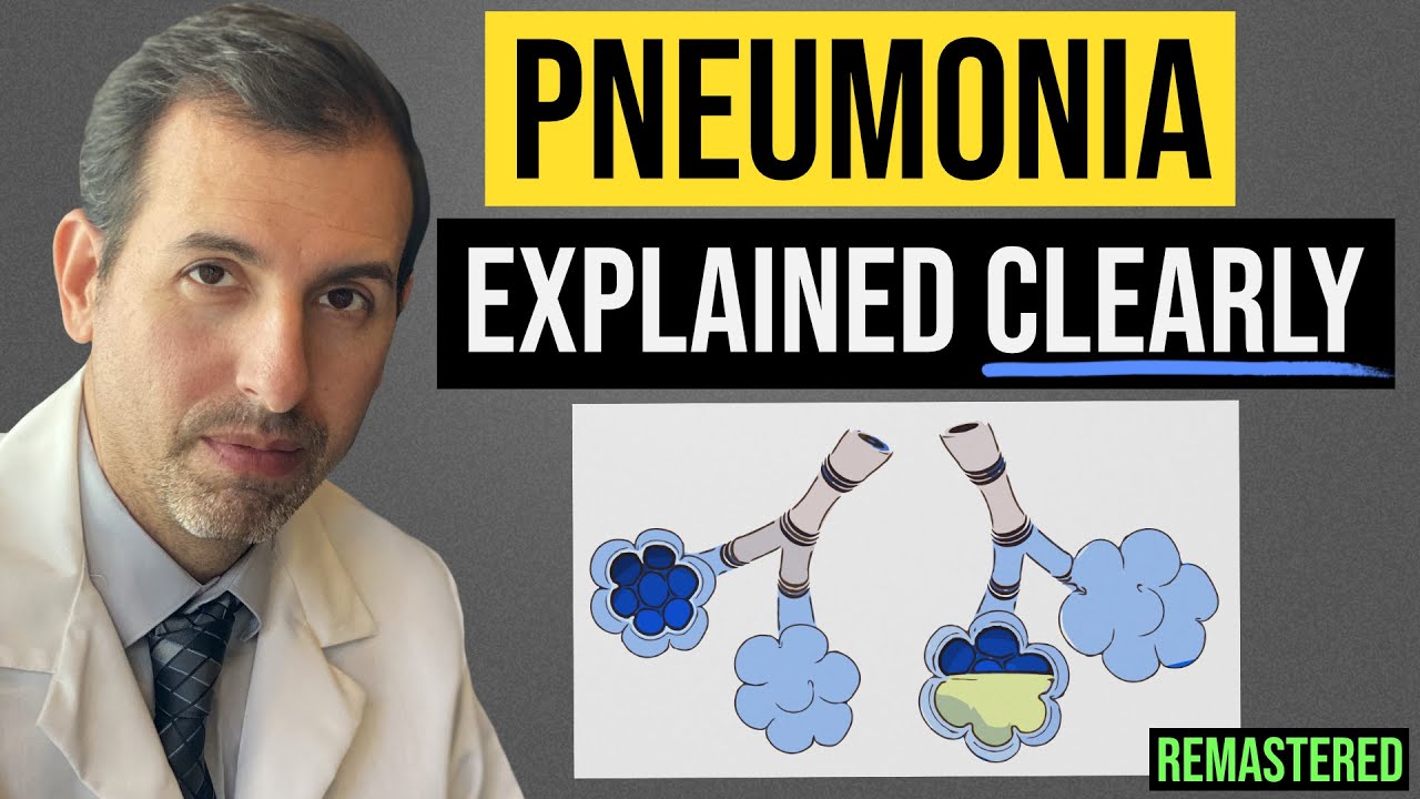 Pneumonia Explained! Symptoms, Diagnosis, Labs, Treatment
