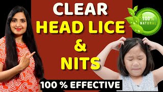 HOW TO REMOVE HEAD LICE  & NITS / Treat Lice Without Chemicals / Natural Remedy/ #Headlice #Haircare