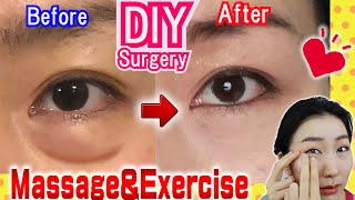 How to Remove Under Eye Bags👁️ Naturally in 7 Days Massage & Exercises🙋