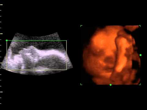 Gino91 - Ecografia 10 LIVE.