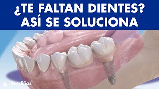 ¿Te faltan dientes? 4 soluciones de PRÓTESIS SOBRE IMPLANTES para reponer DIENTES CAÍDOS © - Clínica Dental Pardiñas