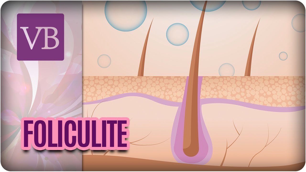 Foliculite + Receitas Caseiras - Você Bonita (21/06/17)