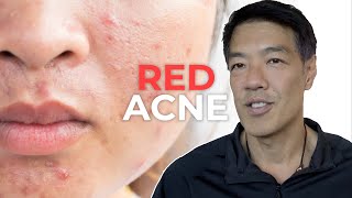 Everything about Red Acne Scars | Dr Davin Lim