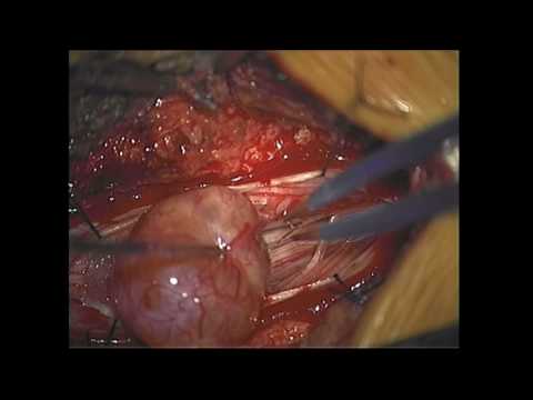 Intradural Tumor in Lumbar Region