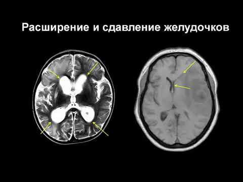 Остеохондроз шейного отдела позвоночника внутричерепное давление Боли и напряжение в мышцах спины