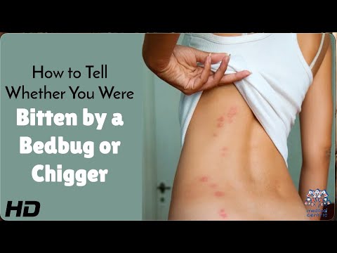Bug Bite Mystery Solved: Bedbugs or Not?