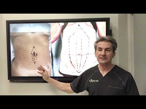 What are the different techniques for repairing the diastasis recti by Dr. Iraniha