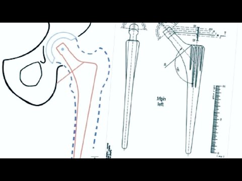 Step-by-Step Approach to templating in Total Hip Replacement