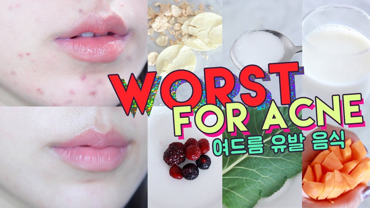 WORST FOODS FOR ACNE! • Get Rid of Hormonal Acne Naturally 🌴 Liah Yoo