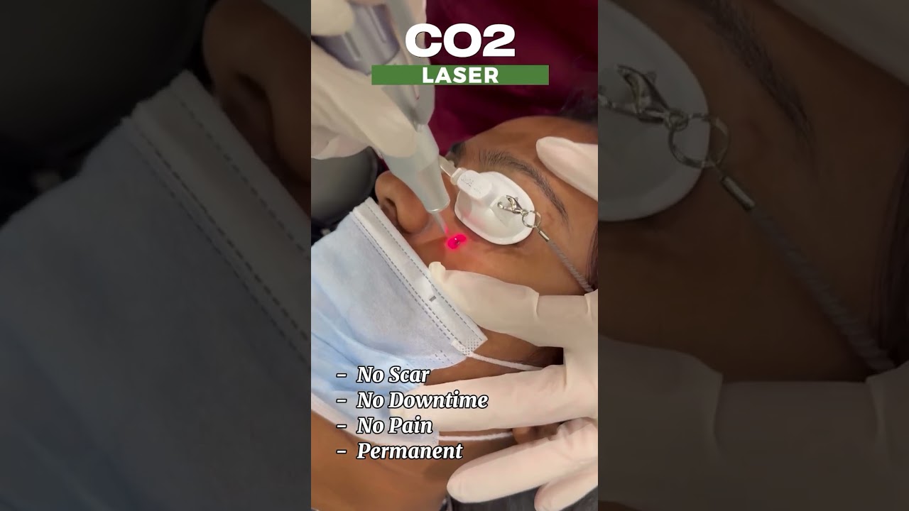 Say goodbye to moles with precision!