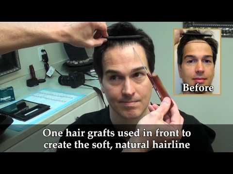Jeff's Undetectable Scar: 1yr