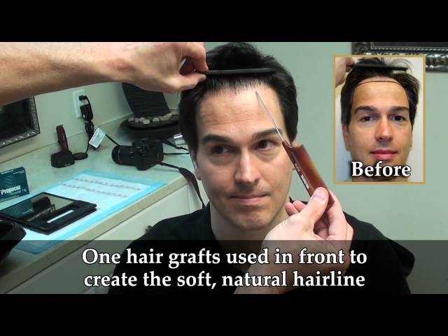 Jeff's Undetectable Scar: 1yr