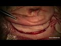 The Best 20 Mastoiditis Tympanic Membrane Color