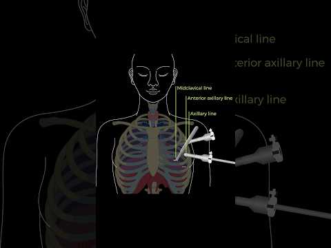 Key Steps for a “Robotic Thymectomy for Myasthenia Gravis #medicine #learn #doctor #surgeon #anatomy