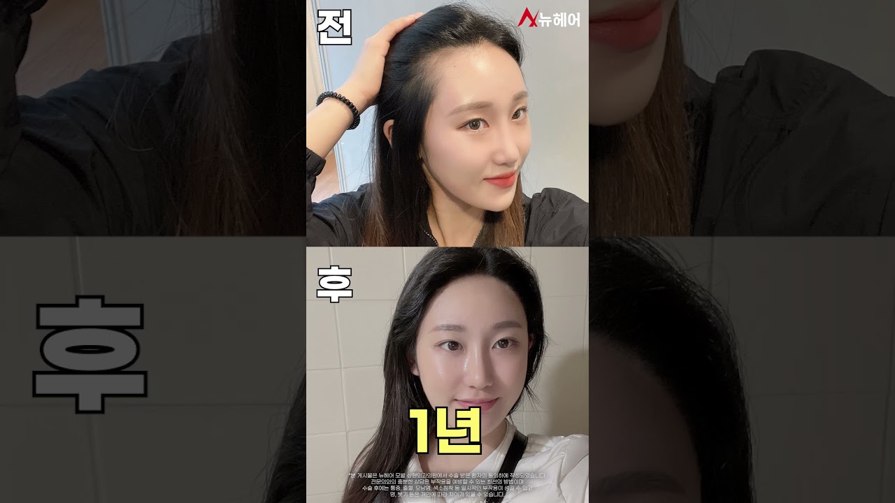 发际线矫正毛发移植第二天开始1年后期ㅣ1200毛囊