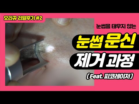 눈썹문신 제거 눈썹 태우지 않고 제거하는 신박한 방법 실제 시술과정 & 경과 비교 총정리 - 오라뀨 리얼후기