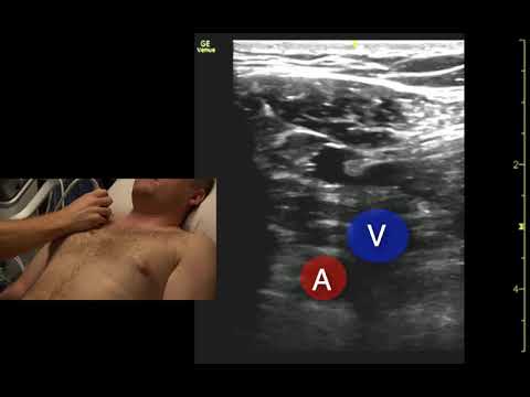 Subclavian Vessels Ultrasound Scanning Technique