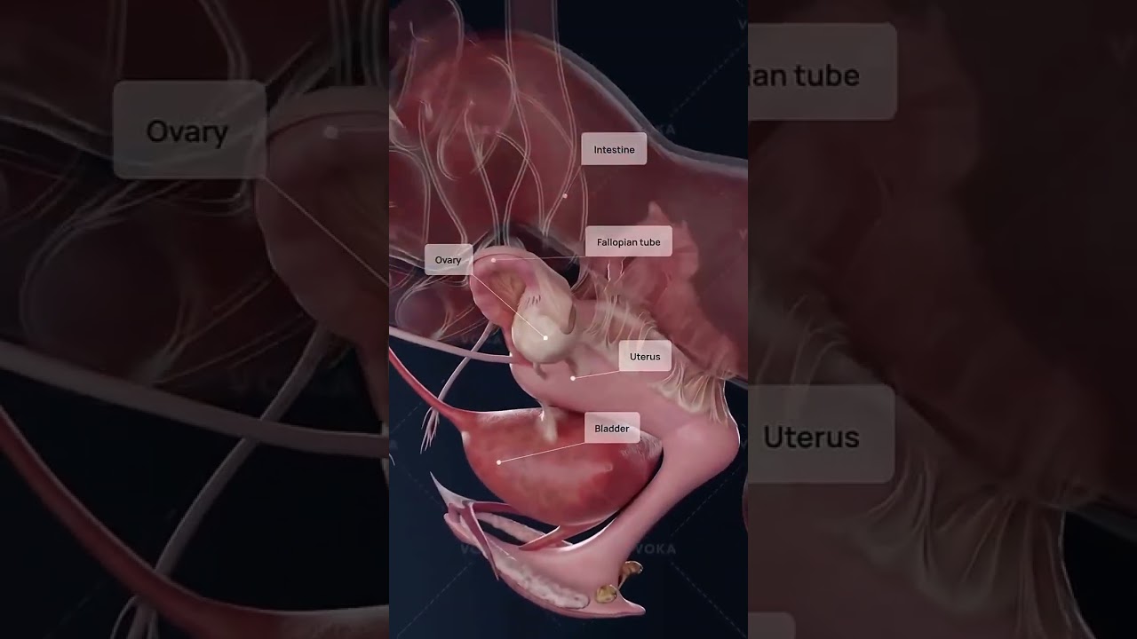 What does stage 4endometriosis really look like inside the body?