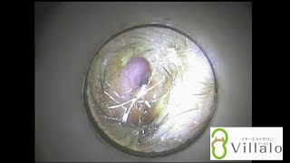 耳掃除動画vol.7「奥はキレイなアメ耳さん」