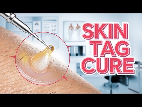 How to Remove Skin Tags and Warts Overnight