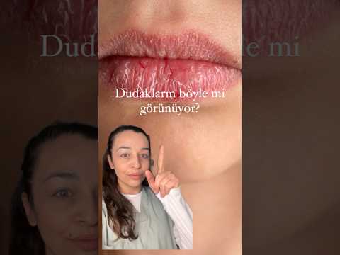 Dudak Kuruluğu, Çatlamış Dudaklar: Dermatolog Önerileri  Dry,Chapped Lips: Dermatologist Suggestions