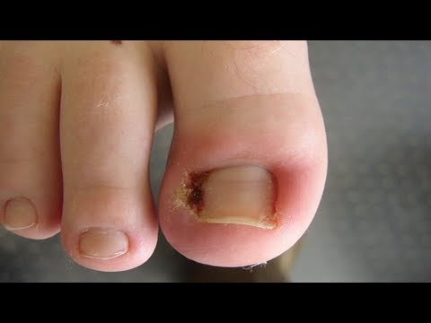 Neue Kartoffeln und Typ-2-Diabetes Diabetische Fußchirurgie