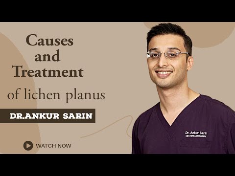 How to treat lichen planus | Lichen Planus Treatment | Lichen Planus skin disease | Hindi