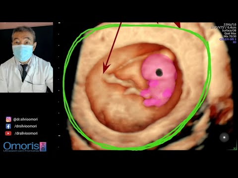 Gestação 9 semanas