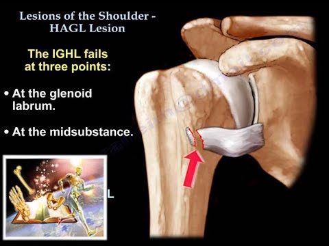 Lesions Of The Shoulder HAGL Lesion - Everything You Need To Know - Dr. Nabil Ebraheim