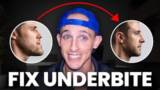 FIXING an Underbite…everything you need to know | Orthodontist explains