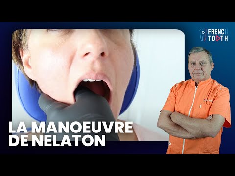 How to reposition a dislocated jaw using the Nelaton Maneuver? - Dr. Pourrat