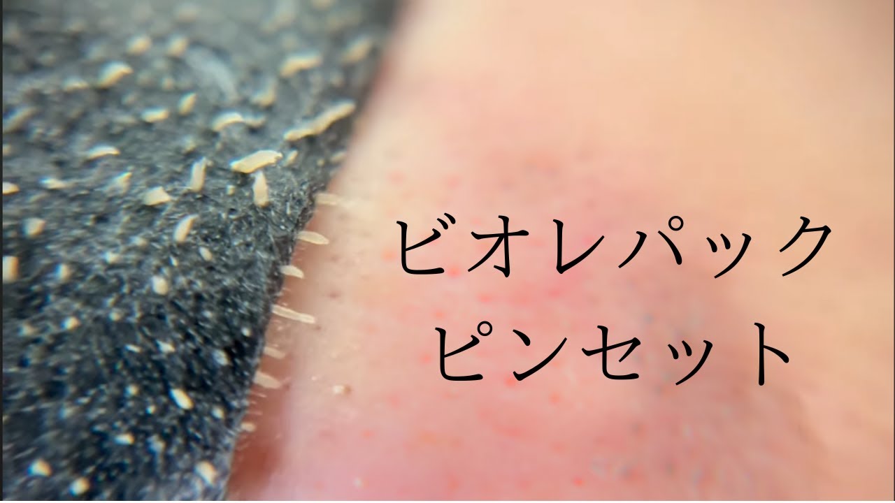 今日も毛穴パックとピンセット