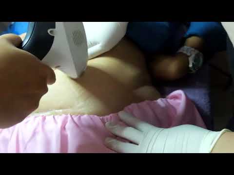 Penurunan berat badan dari ekstremitas bawah Berat badan operasi cepat