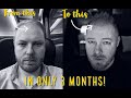 My Hair Transplant Results After 3 MONTHS