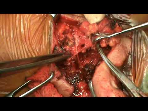 Re Do Total Conservative Parotidectomy