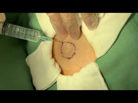 Cystic Acne Extractions