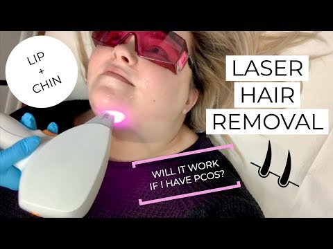 download lagu mp3 mp4 Laser Hair Removal Not Working On Chin, download lagu Laser Hair Removal Not Working On Chin gratis, unduh video klip Laser Hair Removal Not Working On Chin