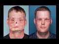 Man receives face transplant after suicide attempt