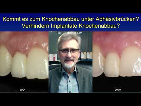 Kommt es zum Knochenabbau unter Adhäsivbrücken?