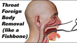 How a Fishbone (or Other Foreign Body) is Removed from the Throat!
