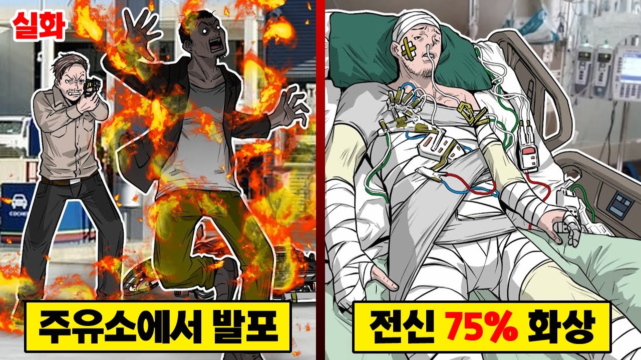 【실화】 오사격으로 불덩이가 된 남자... 전신 75도 화상