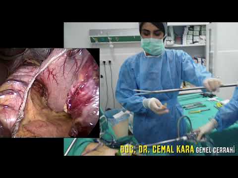 Bariatric Surgery - Gastric Sleeve Live -by  Assoc. Prof. Dr. Cemal Kara