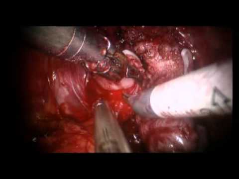 Robotic Assisted Radical Prostatectomy (RARP) - Nerve-Sparing