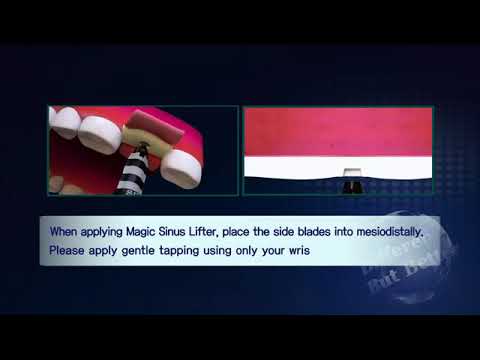 Crestal approach with Membrane Control Animation | Implants Pro Center© | San Francisco