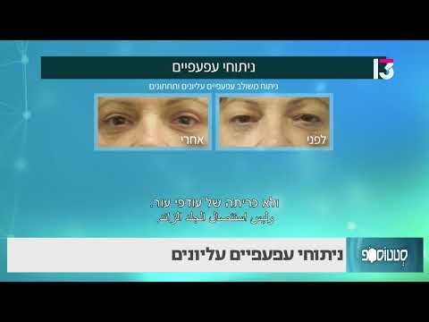 ניתוחי עפעפיים עליונים