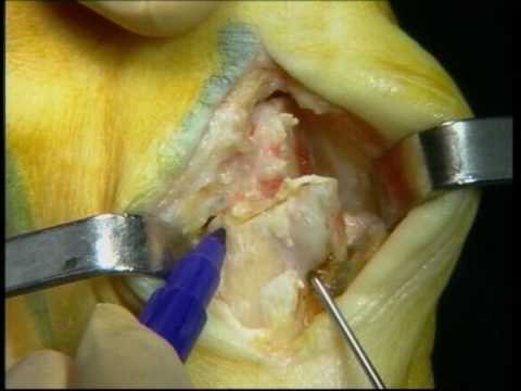 Congiunta del perone Gonfiore alle caviglie su una gamba