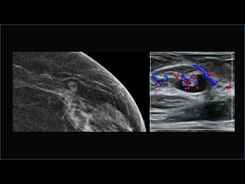 Achados mamográficos e ecográficos típicos dos linfonodos intramamários