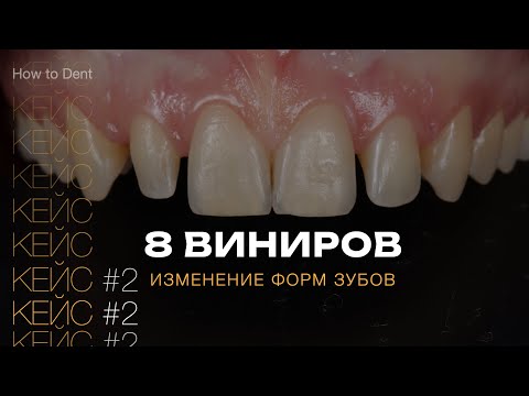 Изменение формы зубов. Виниры. Шиловидные зубы