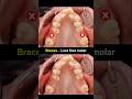 Braces Wheb Lost First Molar Teeth Braces Orthodontist Dentist