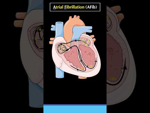 What is Atrial Fibrillation (AF or AFib)  #atrialfibrillation #cardiology #arrhythmia #heart